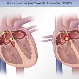 Αρρυθμίες: Κολποκοιλιακή Κομβική Ταχυκαρδία Επανεισόδου (AVNRT) και Κολποκοιλιακή Ταχυκαρδία Επανεισόδου (AVRT)